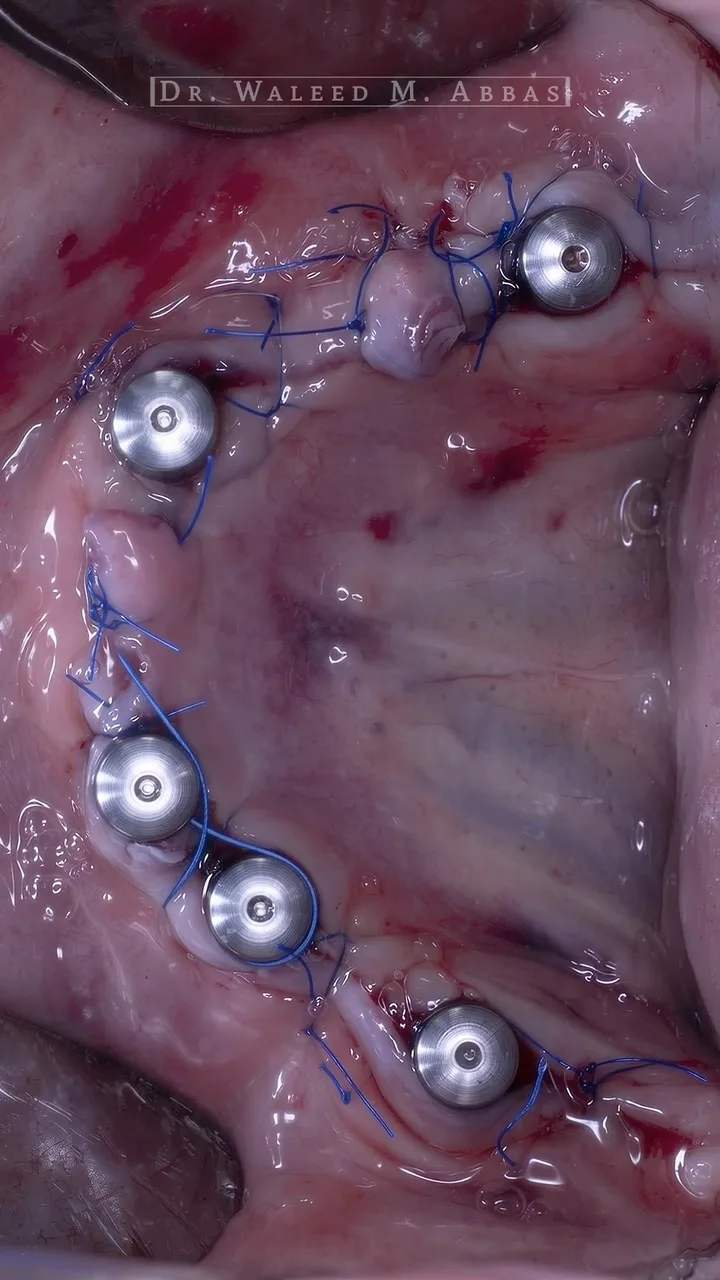Six MULTI-IM® abutments in place, ready for the full-arch prosthesis.