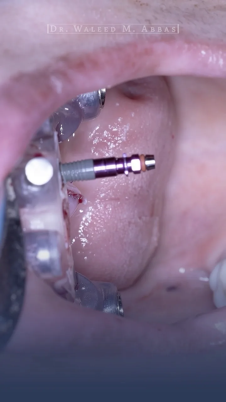 Each implant is carried through its sleeve to the planned depth.