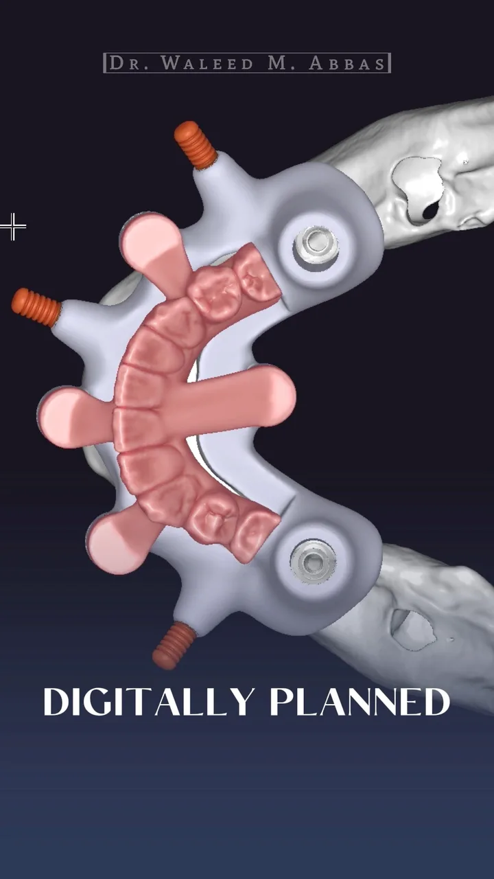 Guide, fixation pins and the planned teeth, designed together on the CBCT.