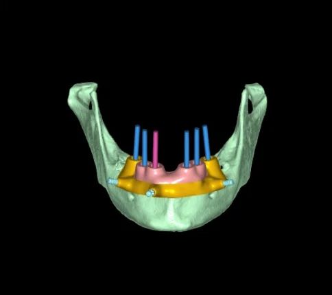 3D plan, frontal view: jaw, surgical guide and implant axes