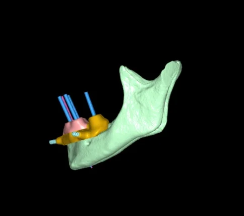 3D plan, left view: jaw, surgical guide and implant axes