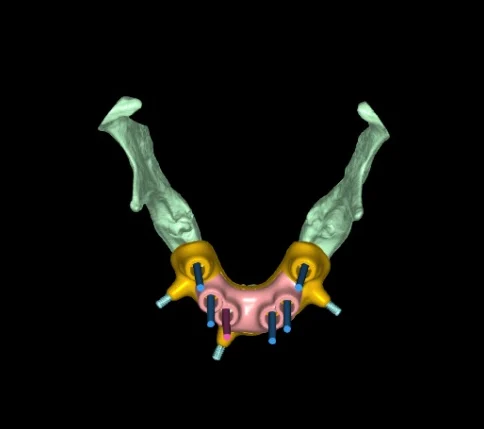 3D plan, occlusal view: jaw, surgical guide and implant axes