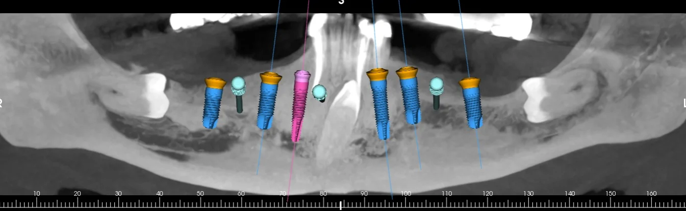 Panoramic reconstruction of the lower jaw with the six planned implants, abutments and fixation pins
