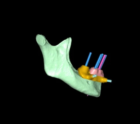 3D plan, right view: jaw, surgical guide and implant axes
