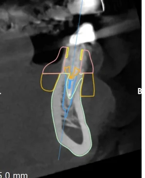 CBCT cross-section through the planned implant at 33
