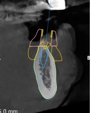 CBCT cross-section through the planned implant at 34
