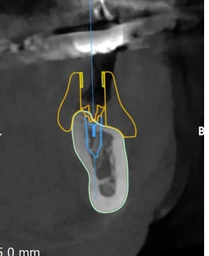 CBCT cross-section through the planned implant at 36