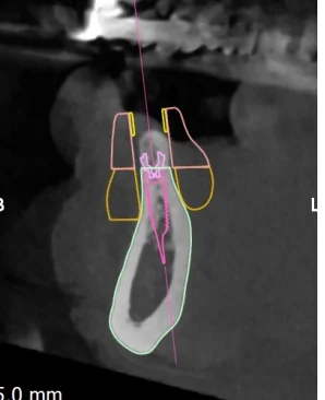 CBCT cross-section through the planned implant at 43