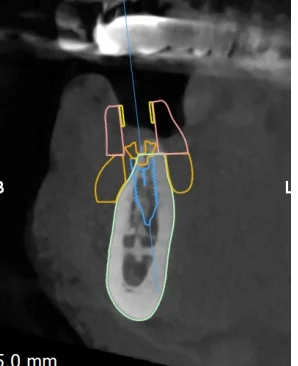 CBCT cross-section through the planned implant at 44