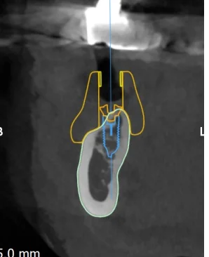 CBCT cross-section through the planned implant at 46