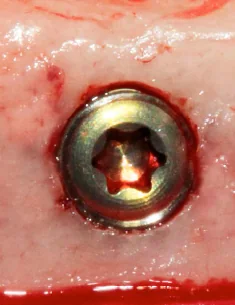 UnicCa® implant placed in a fresh socket