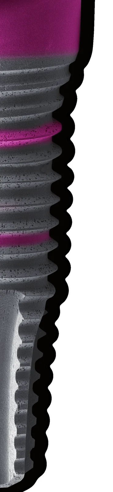 BTI implant showing neck, threads and valleys roughness zones